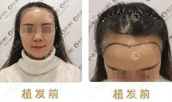 亲身经历记录:女性头顶发际线加密植发4个月恢复期的效果图