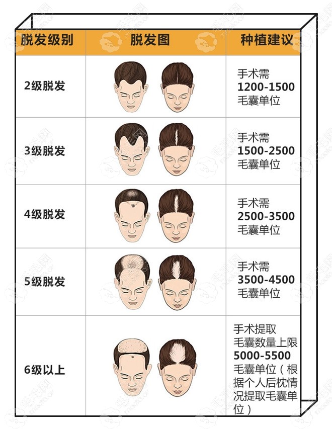 男女性脱发等级表建议种植毛囊单位图解