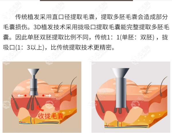 透露下:重庆新生3d植发际线的价格和优势,想看案例图的进来