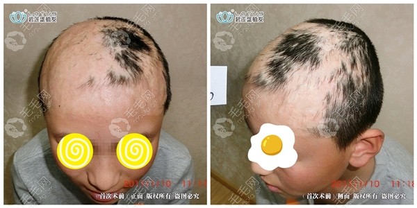 这组疤痕植发的效果图曾经在世界植发大会获得奖项