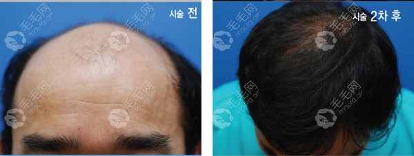 韩国BLACK布莱克头顶大面积植发前后对比图