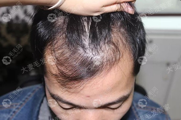 男性脂溢性脱发注定了要秃头?NO,我在大麦植发后验证还有救