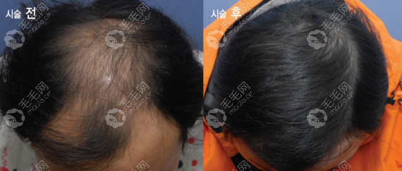 在韩国布莱克毛发移植医院做植发手术的价格是多少韩元呢?