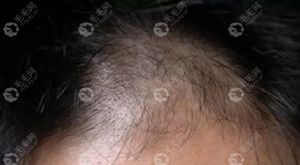 科普:斑秃分为哪几种类型以及展示不同类型斑秃的图片
