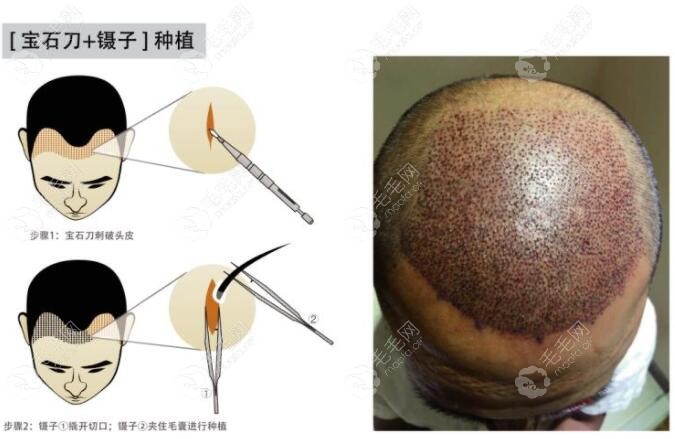 Bht植发和fue植发区别(bht和bht20植发区别)