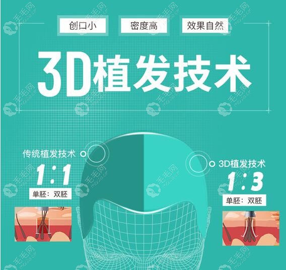 杭州新生3D植发技术优惠在这