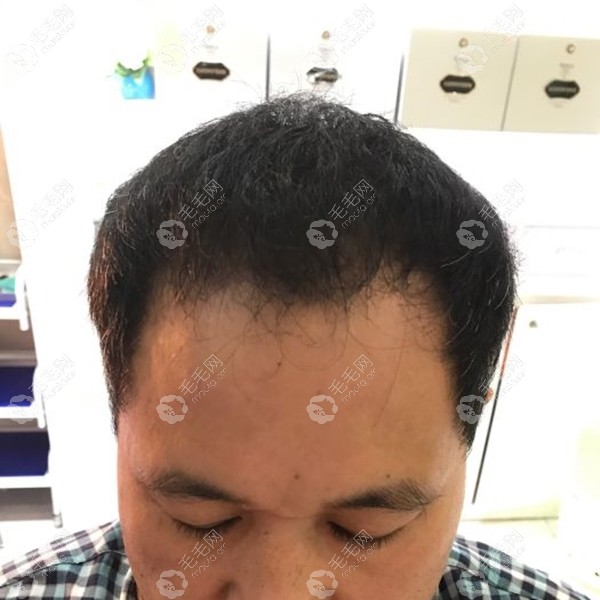 看我在长沙大麦微针头顶植发6000单位的效果图_长沙大麦微针(原科发源