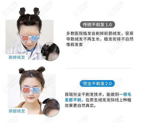 杭州首瑞不剃发2.0技术可以种植绒毛