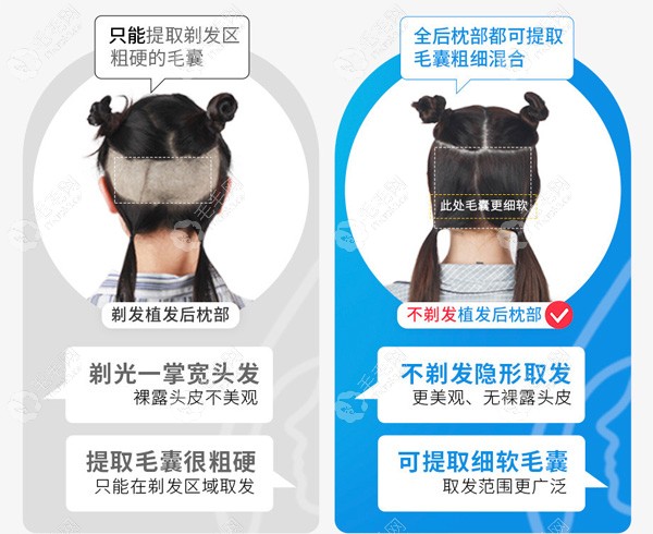 杭州首瑞不剃植发技术优势