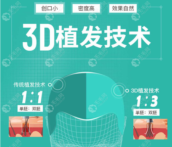 北京新生3d植发技术优势