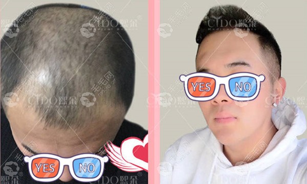 北京熙朵李会民男士头发加密种植效果