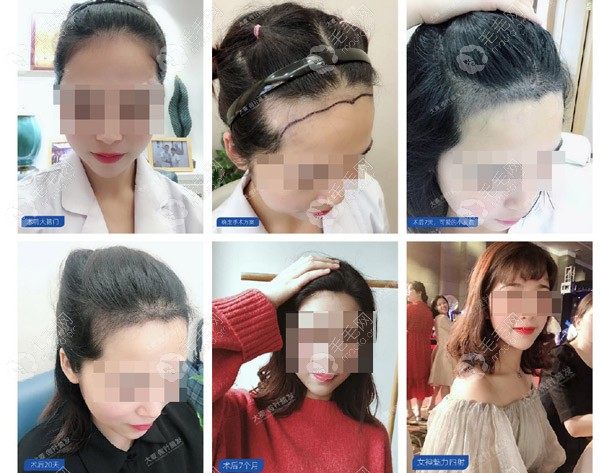 大麦微针(科发源)通过微针种植的技术对顾客进行了种植