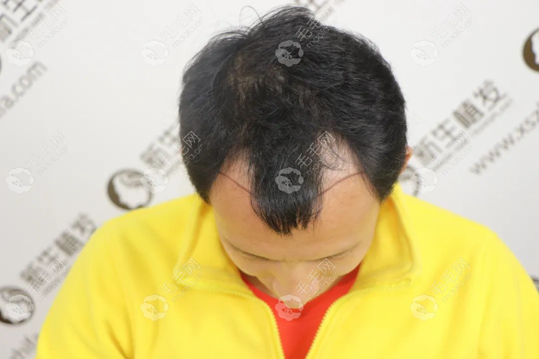 额角发际线后移严重,来晒图在宁波新生植发3000单位的效果