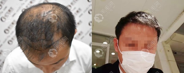 在新生毛发专科植发6个月后的效果