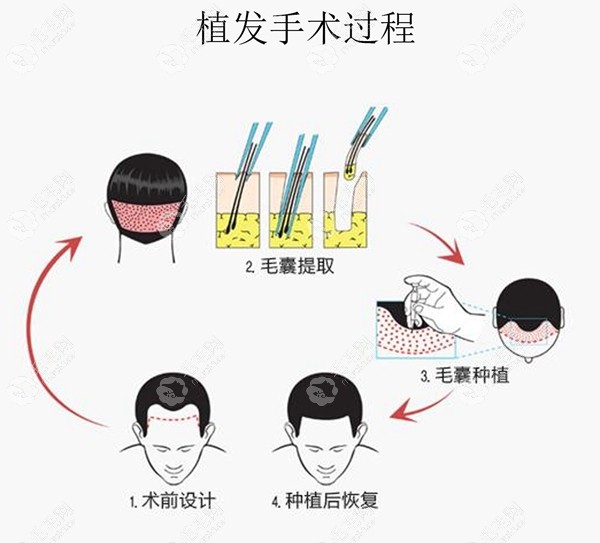 植发手术的过程图