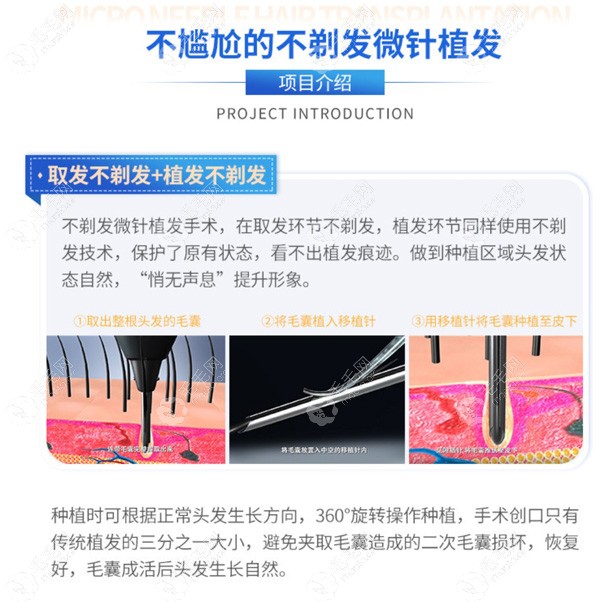 不剃发植发技术的植发医院汇总这些机构无需剃头就能植发