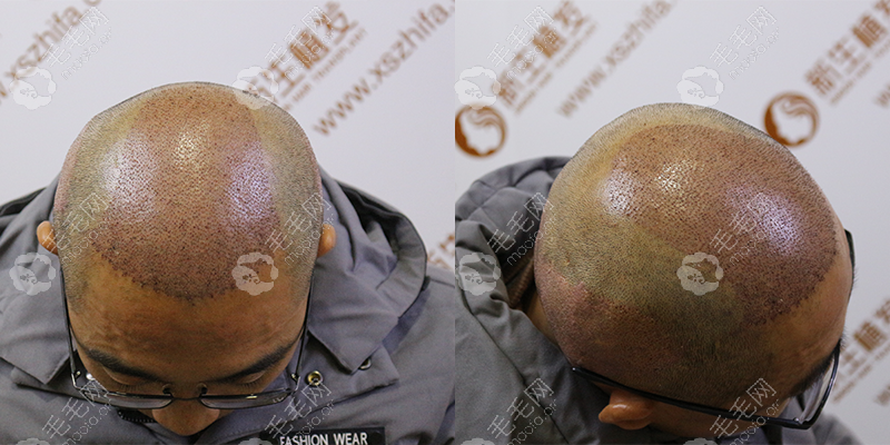种头发价格植发大概多少钱