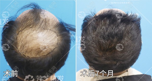 郑州芳艺男士发际线+头顶种植术后效果