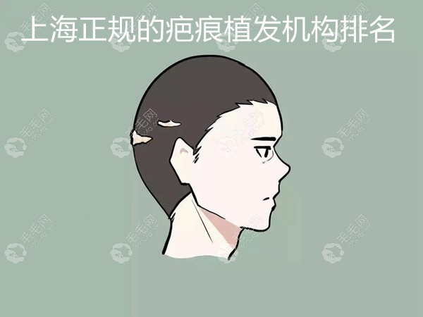 上海正规的疤痕植发机构排名揭榜,有了它就知道去哪里好了