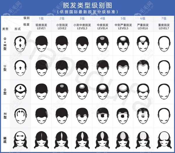 这里有男/女脱发1-7级的级别示意图与需要植发的单位数量