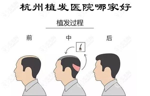 杭州哪家植发医院技术比较好