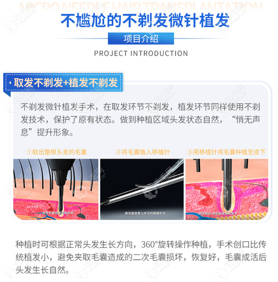 北京大麦微针不剃发植发技术优势