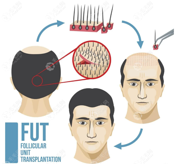 FUT毛发移植技术