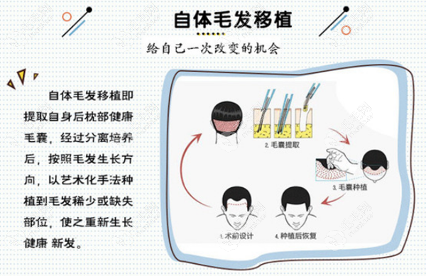 中信惠州自体毛囊移植过程