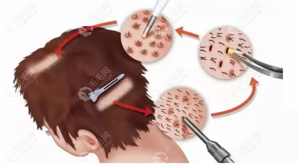 fut植发过程演示