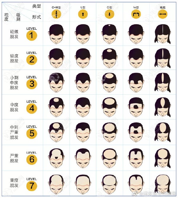 脱发等级和植发数量对照表