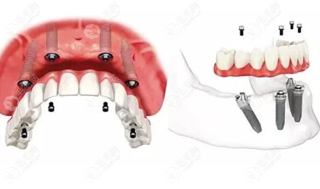 allon4半口种植牙示意图
