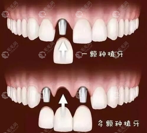 种植牙和原生真牙有什么区别