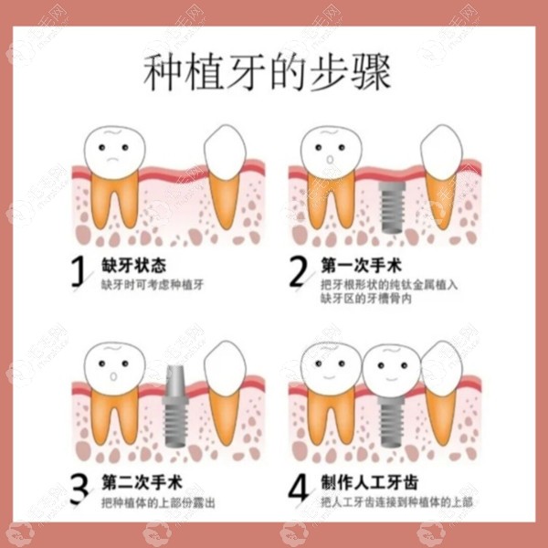 种植牙详细流程步骤图