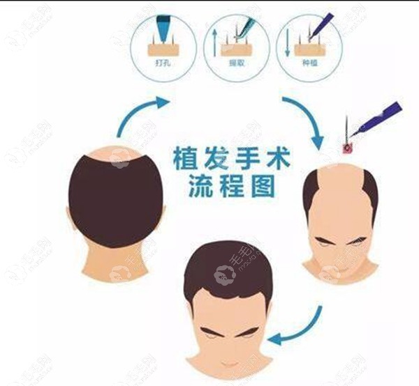 传统普通植发流程