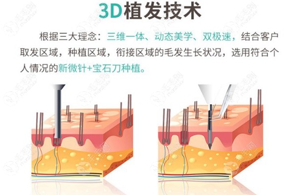 宁波新生植发医院——3D植发