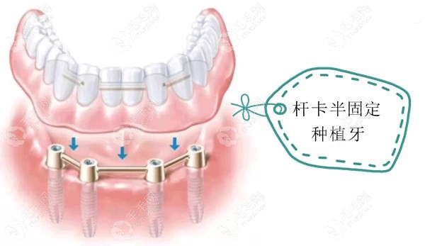 做种植牙用半固定和全固定的哪种修复方式更好呢