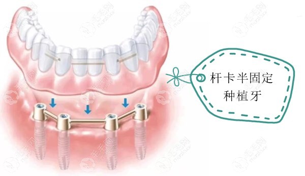 杆卡式半固定种植牙