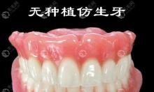 日式无种植仿生牙是什么原理?老人用仿生牙和种植牙哪个好