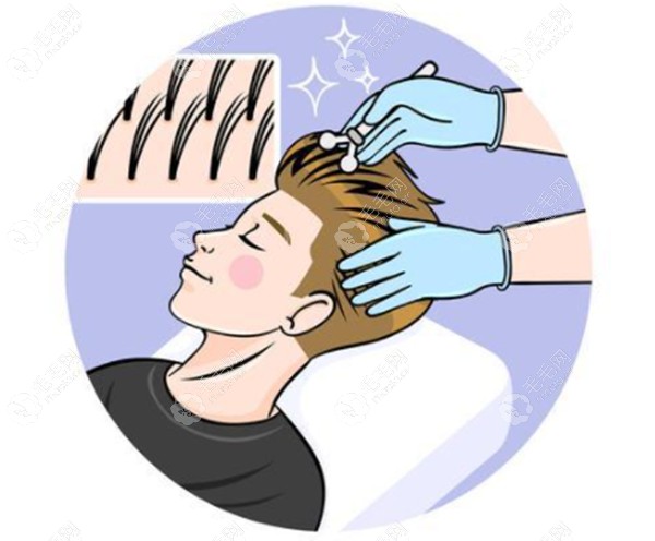 NHT不剃发植发技术可以达到种完就美，不用度过尴尬期