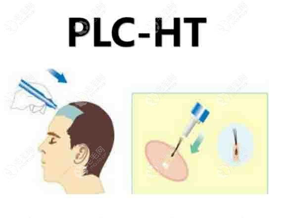 PLC-HC毛囊焕活微针技术种植过程图