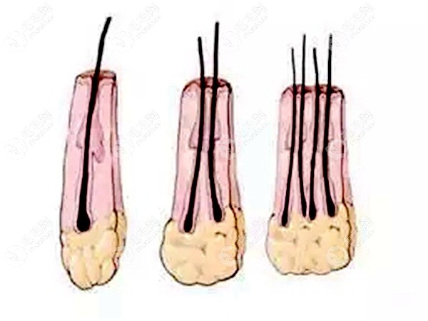 前额光秃秃想调整发际线的发友们,500株就相当于500个毛囊单位,一个