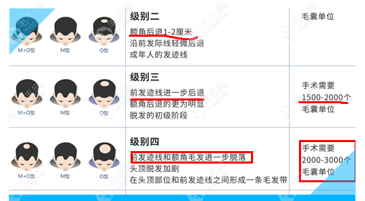 植发要多少毛囊(植发要多少毛囊单位)