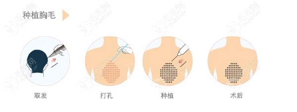 种植胸毛的流程