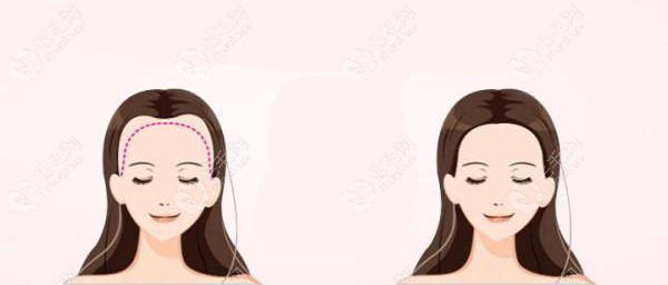 额头缩小和发际线植发都能改善额头高