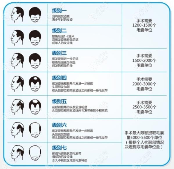 高额头有明显m型的发际线已经到脱发3级了.