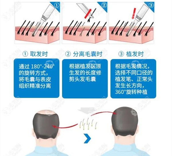 微针植发手术操作过程