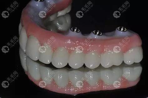 全口覆盖性义齿修复技术