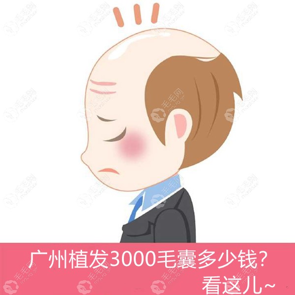 广州植发3000毛囊的费用请收,戳种3000个单位/3000根头发多少钱