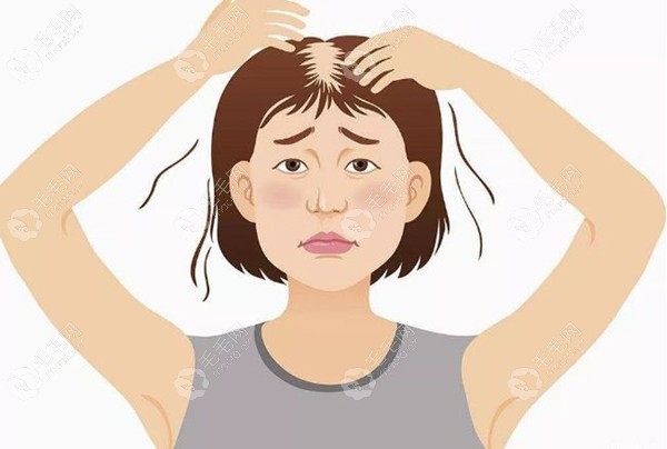 女生头顶头发稀疏可以植发,这有女性头顶加密植发图片参考
