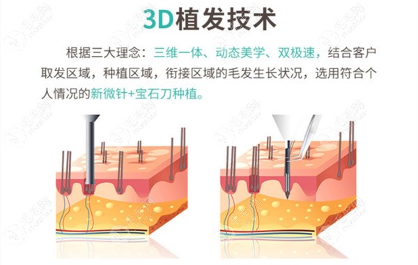 杭州新生3D植发技术的优势